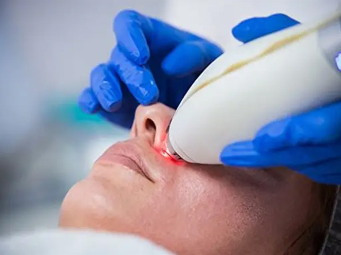 Лечение купероза и сосудистых сеточек