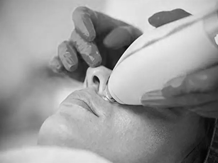 Лечение купероза и сосудистых сеточек