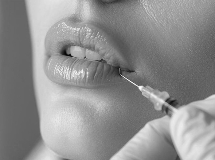 Коррекция лица филлерами