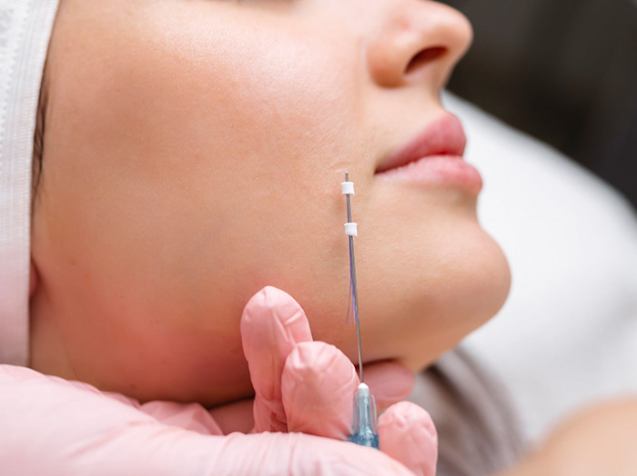 Нитевой лифтинг и мезонити