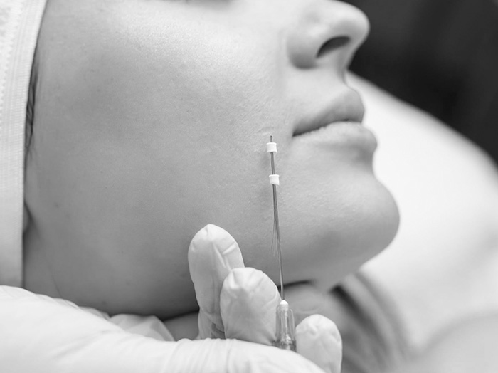 Нитевой лифтинг и мезонити