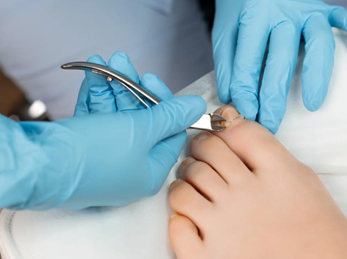 Лечение вросшего ногтя