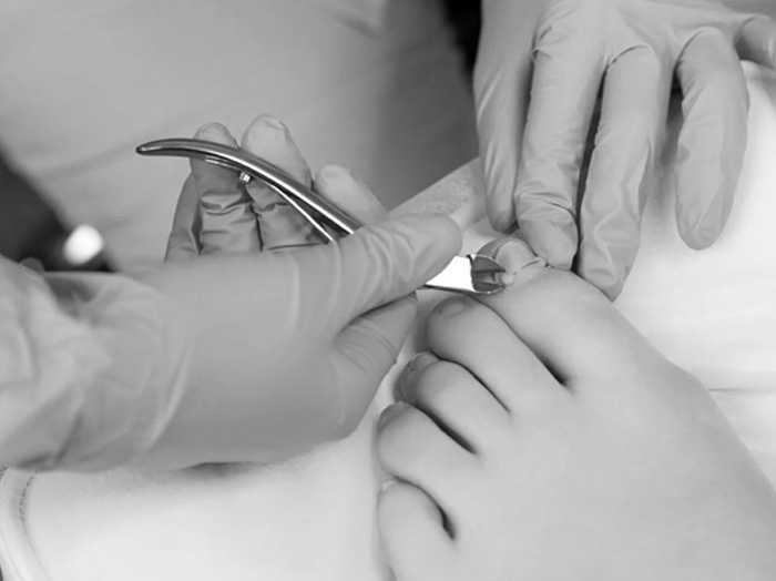 Лечение вросшего ногтя