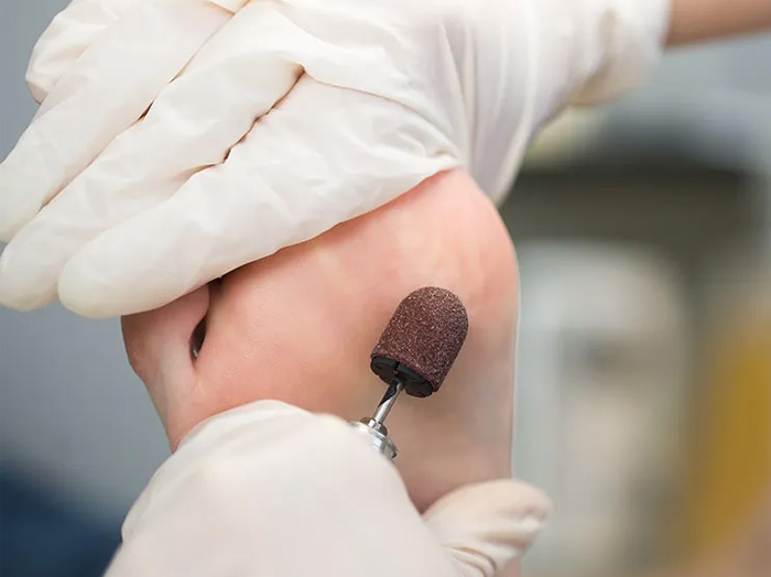 Удаление мозолей и натоптышей