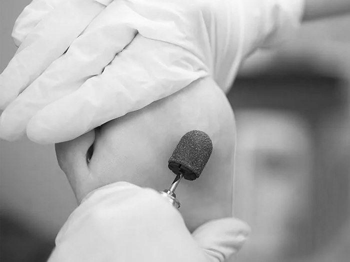 Удаление мозолей и натоптышей