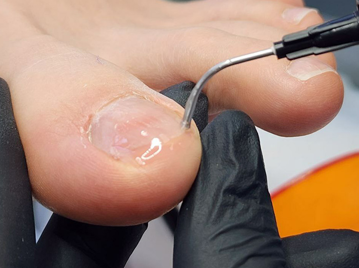 Протезирование и восстановление ногтя