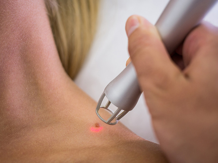 Удаление новообразований и сосудов