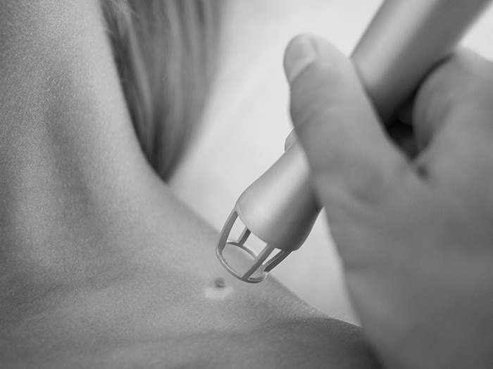 Удаление новообразований и сосудов