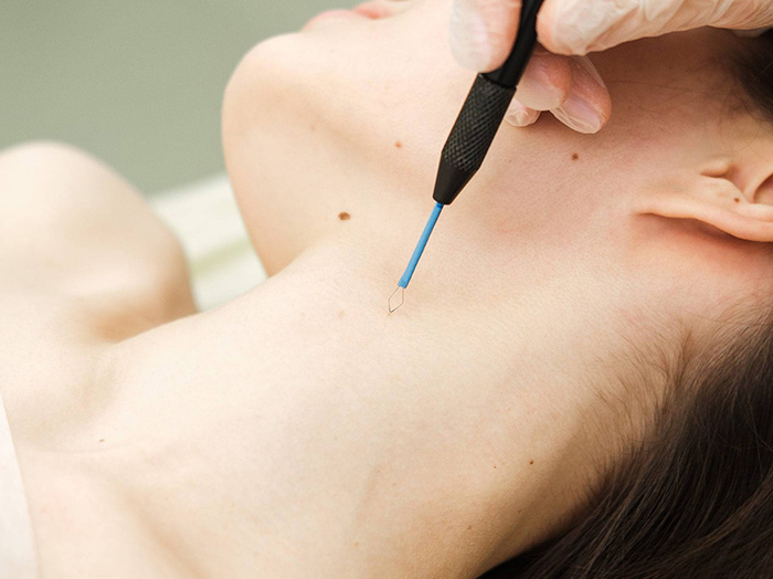 Электрокоагуляция