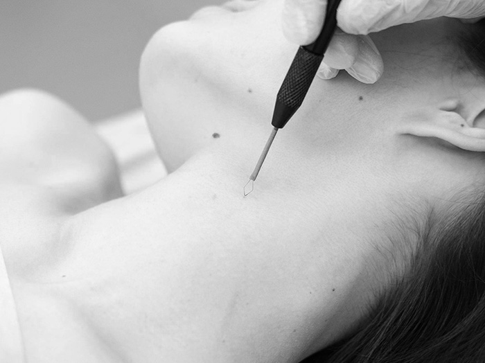 Электрокоагуляция