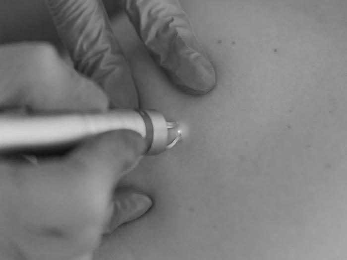 Удаление сосудов и ангиом