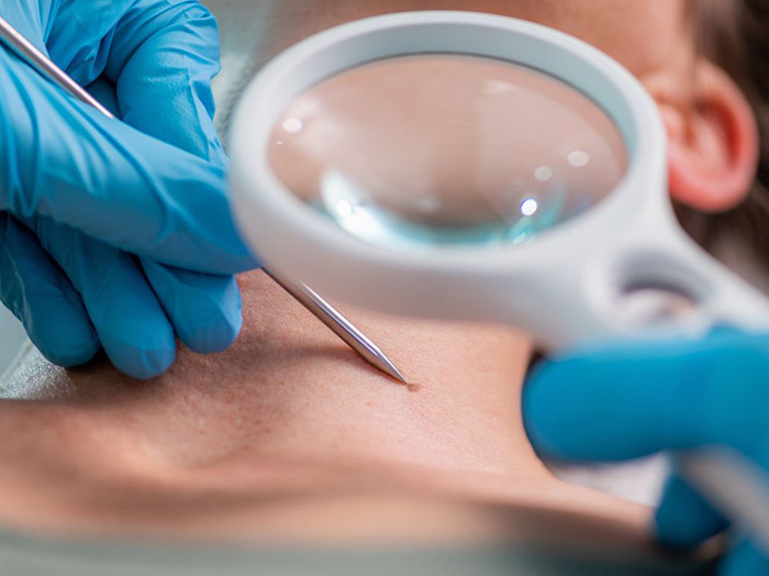 Удаление папиллом