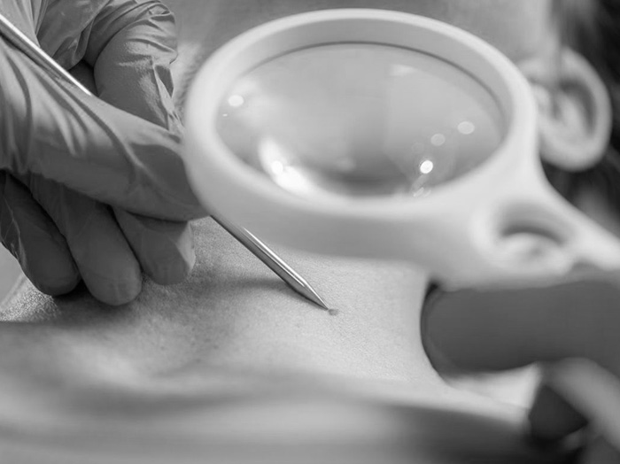 Удаление папиллом