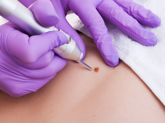 Удаление родинок (невусов)