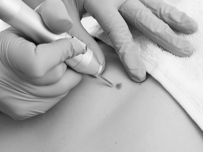 Удаление родинок (невусов)