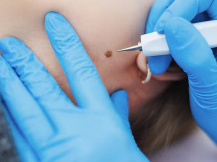 Удаление кератом