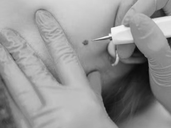 Удаление кератом