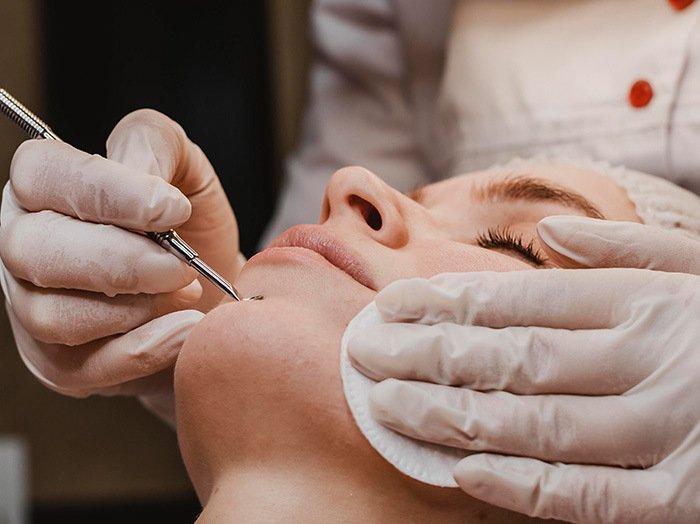 Удаление милиумов (белых угрей)