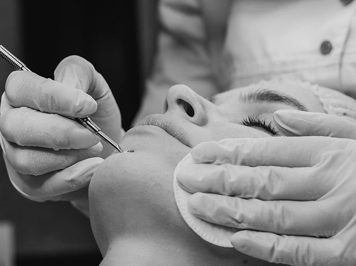 Удаление милиумов (белых угрей)