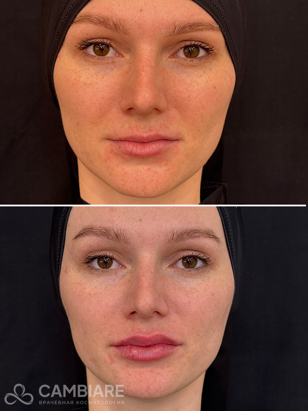 Коррекция тонких губ филлерами