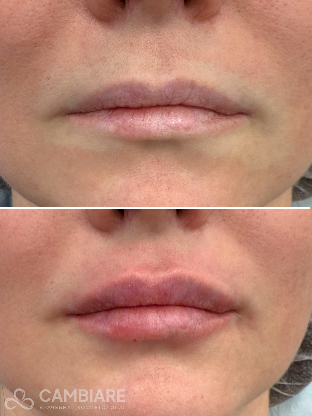 Коррекция асимметрии губ и деликатный объём филлерами