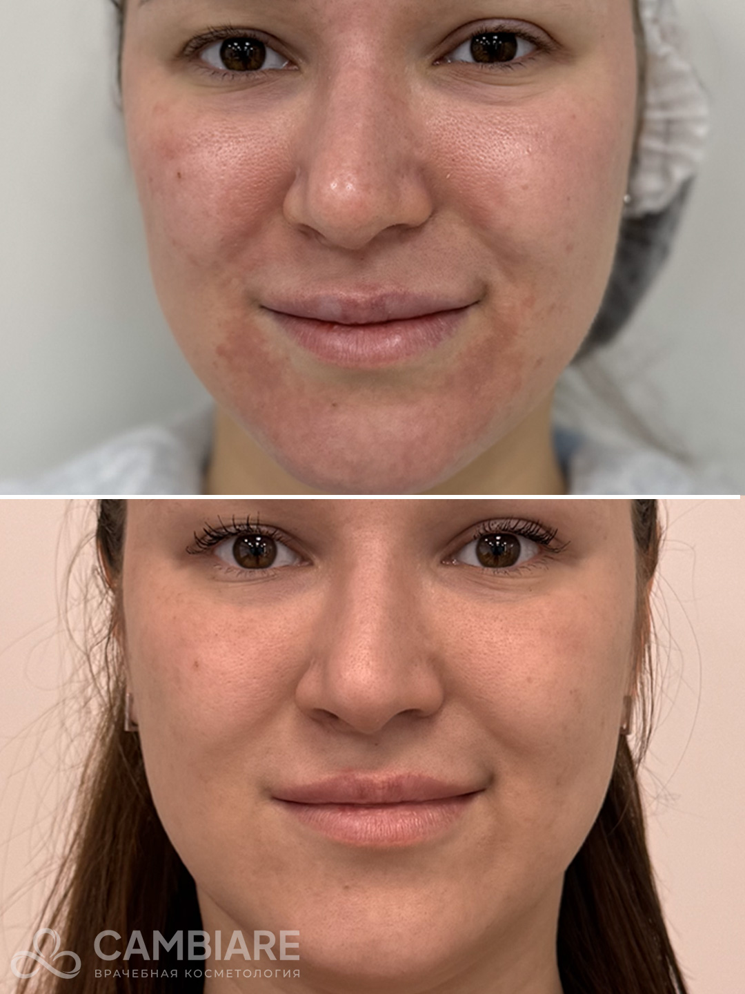 Лазерная шлифовка и фотоомоложение