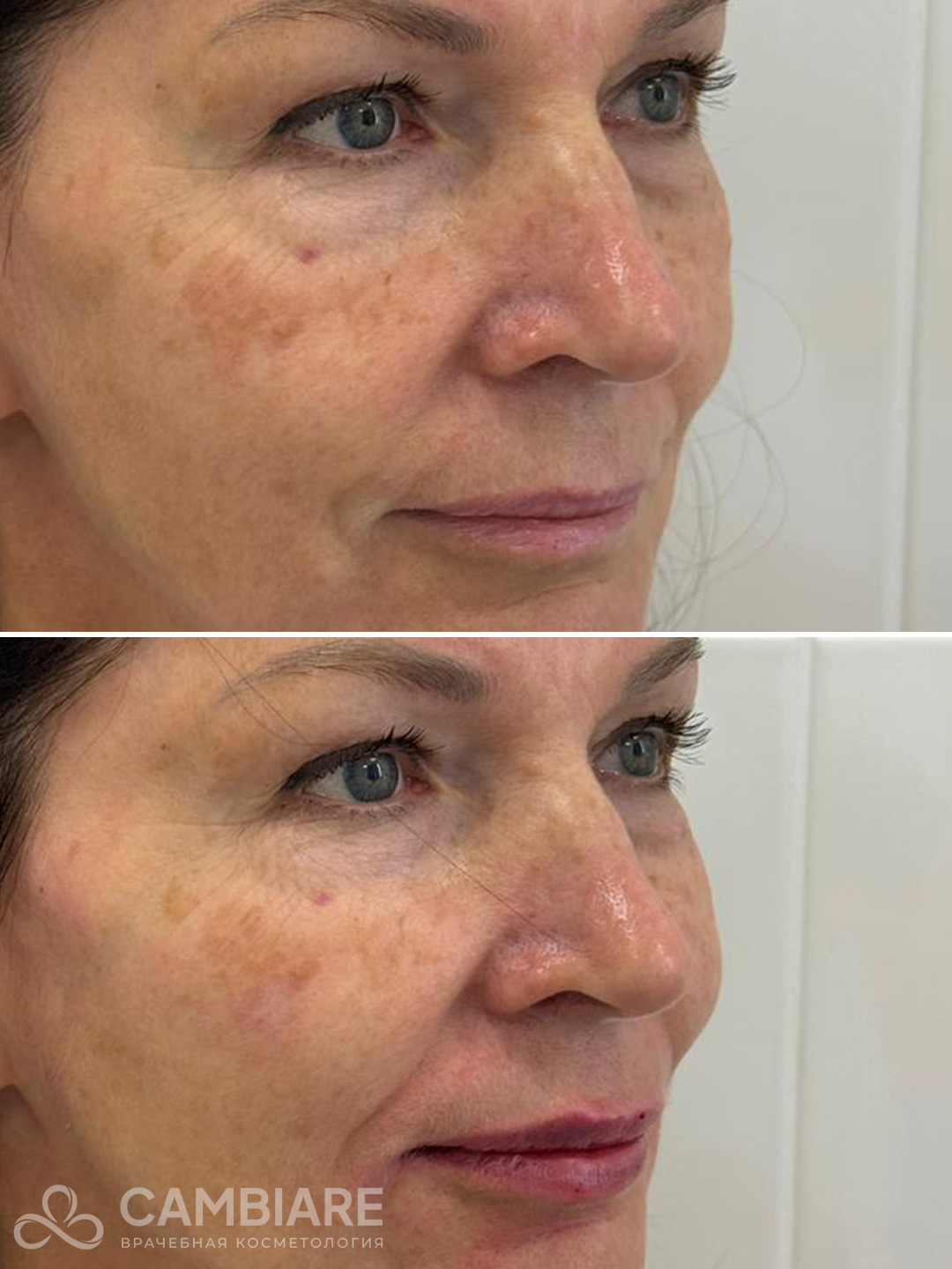 Коррекция средней и нижней трети лица