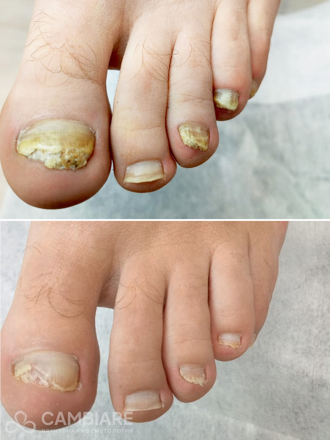 Обработка грибкового поражения