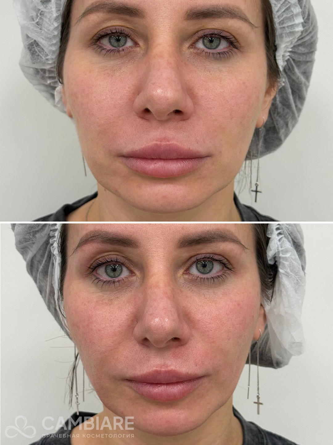 Термолифтинг Oligio