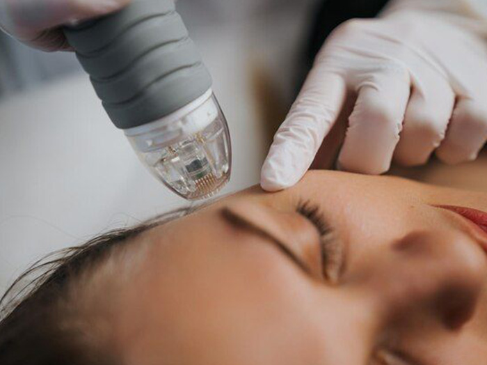 Монополярный RF лифтинг Oligio