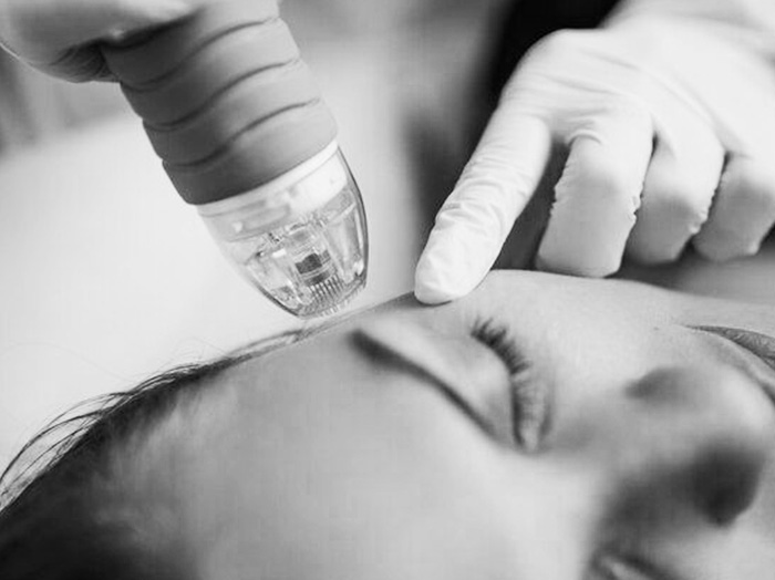 Монополярный RF лифтинг Oligio